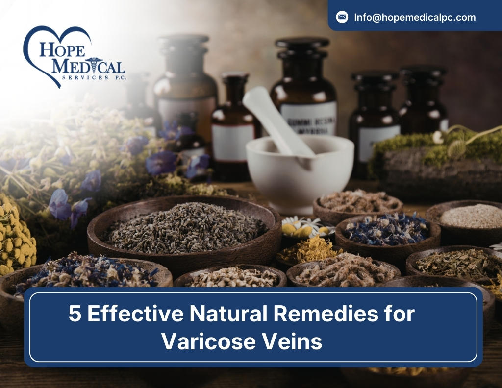 5 Effective Natural Remedies for Varicose Veins