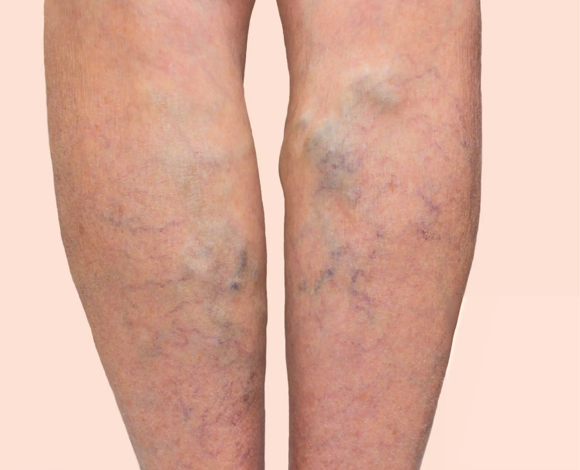 HopeMedical-Varicose Vein-Image-01